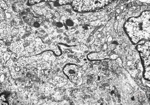 F,11y. | ependymoma F,11y. | ependymoma